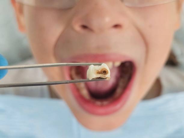 Best Emergency Dental Care for Sports Injuries in Anson, TX